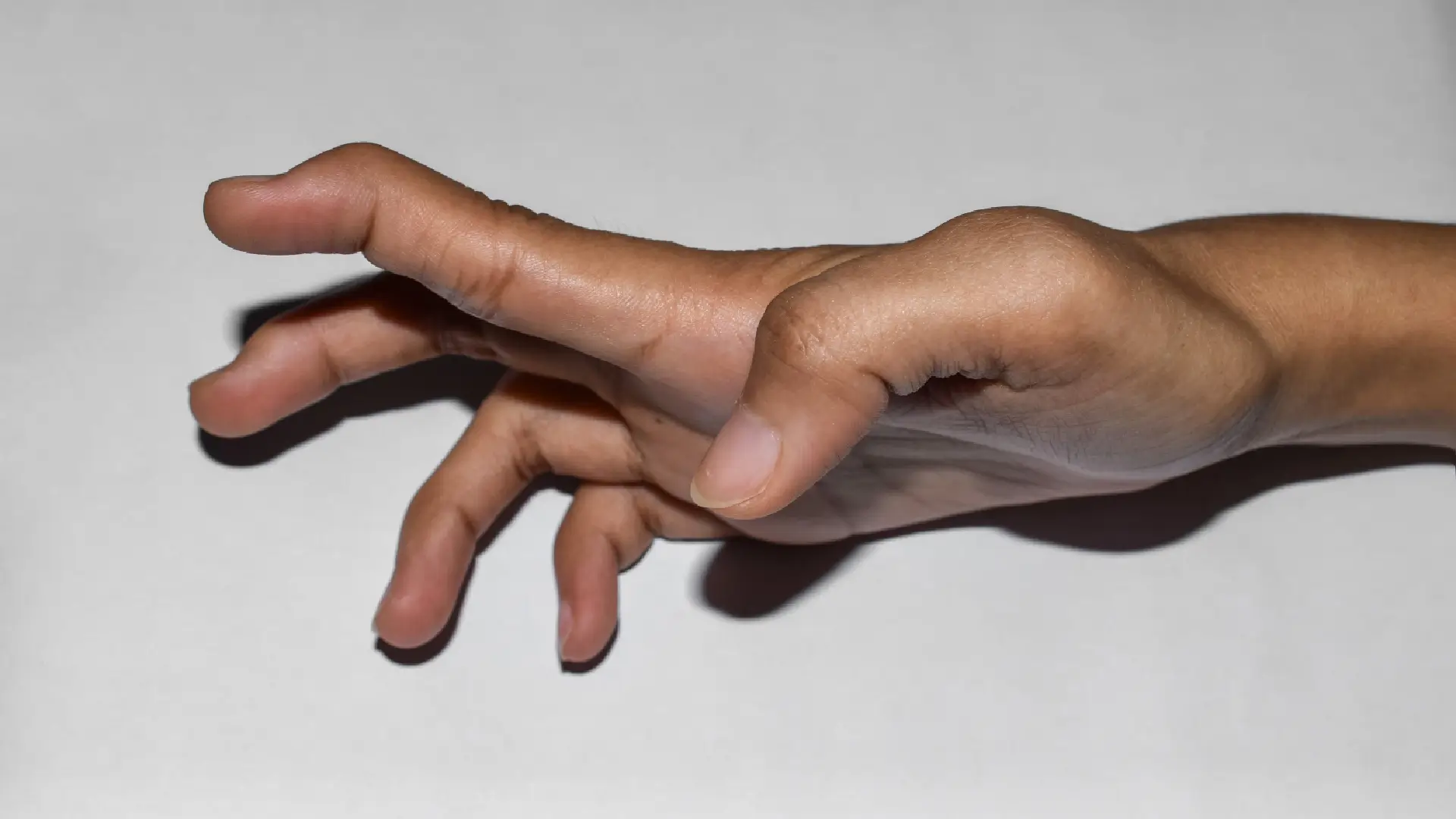 Botox for Spasticity
