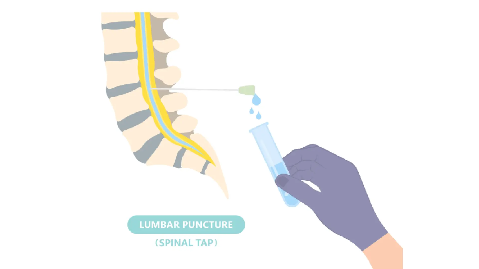 Lumbar Puncture